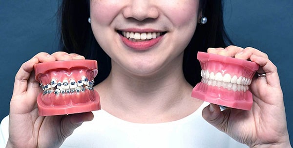 Một số yếu tố tác động đến thời gian niềng răng