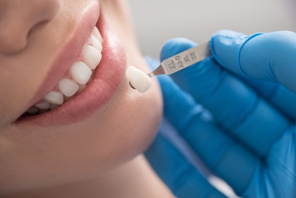 Khi nào cần bọc răng sứ thẩm mỹ?