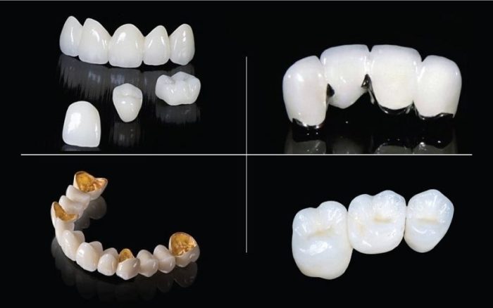 Các loại răng sứ tại Nha khoa Hoàn Mỹ