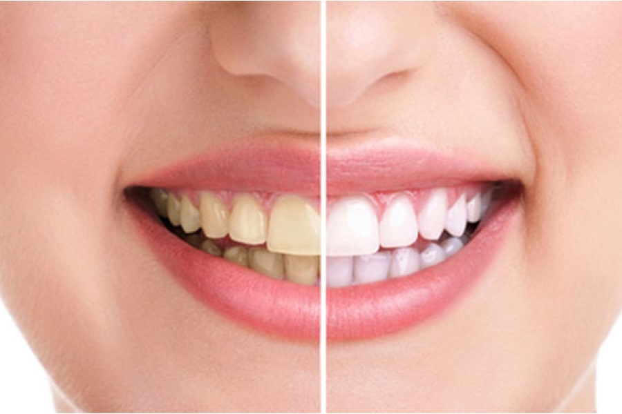 Tẩy trắng răng có tốt hay không?