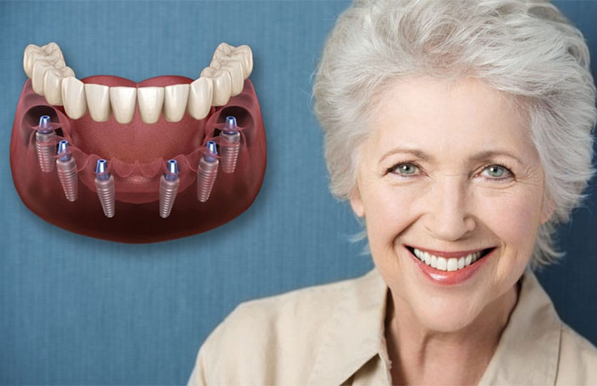 Các trường hợp nên trồng răng implant