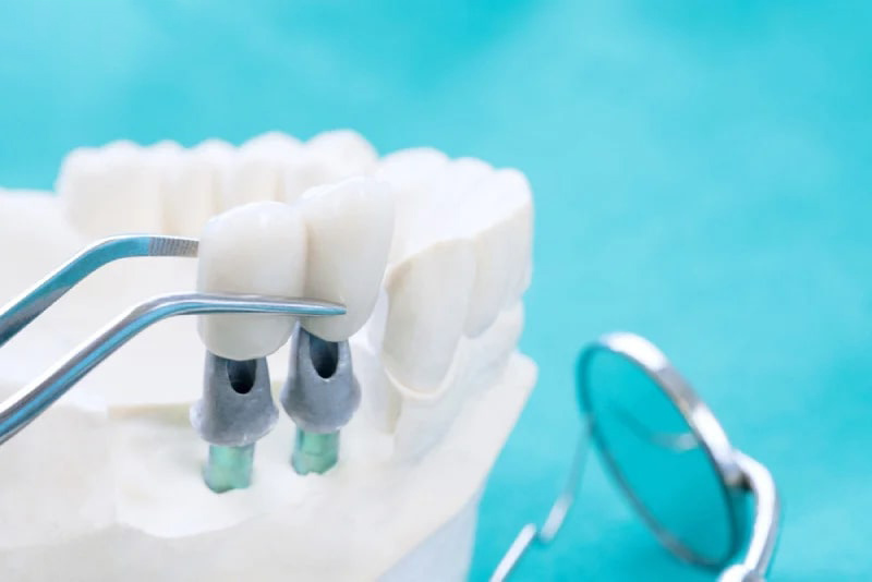 Những điểm nổi bật của việc trồng răng implant