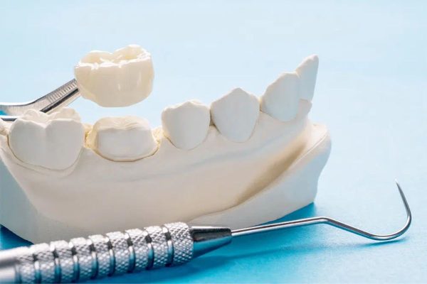 Một số lưu ý để tránh biến chứng sau khi bọc răng sứ