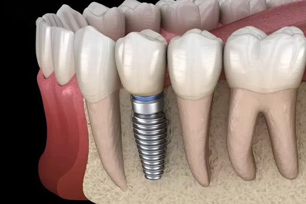 Trồng răng implant giúp ngăn chặn tình trạng tiêu xương hàm
