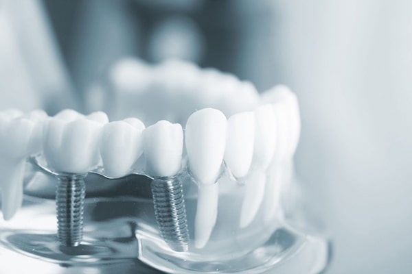 Thời gian trồng răng Implant mất bao lâu?