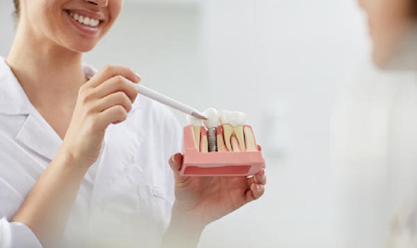 Trồng răng Implant mất bao lâu thì ăn uống bình thường?