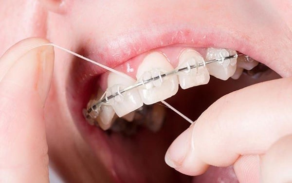 Chăm sóc răng miệng trong khi niềng răng