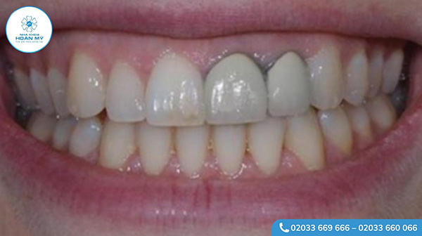 Bọc răng sứ kim loại có thực sự làm đen viền nướu?