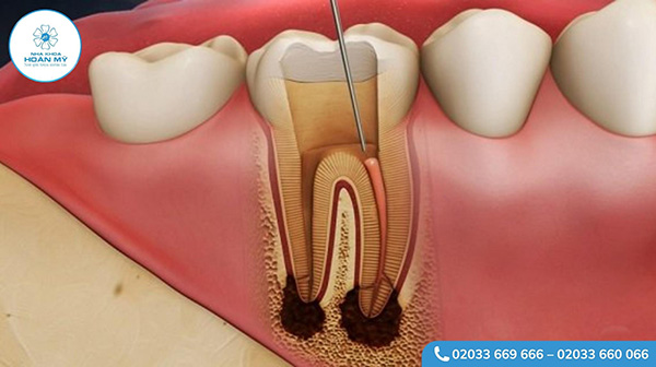 Đau nhức trong quá trình điều trị các bệnh răng miệng như sâu răng, viêm tủy