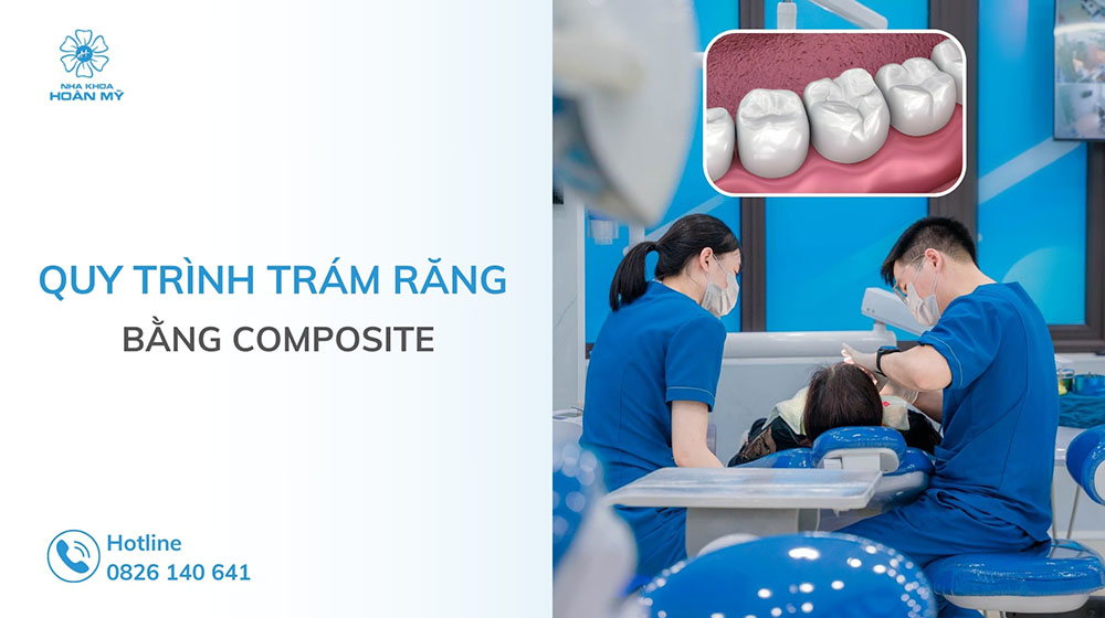 Quy trình trám răng bằng Composite