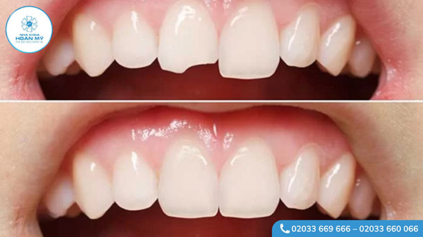 Răng bị mẻ nên trám hay bọc sứ?