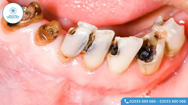 Sâu răng là gì? 